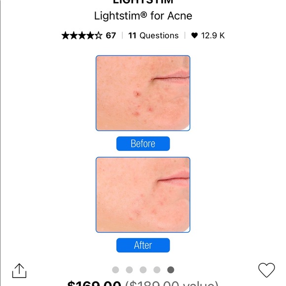 LED LightStim for Acne - Picture 5 of 7